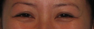 Crows feet present on smiling before Botox treatment.